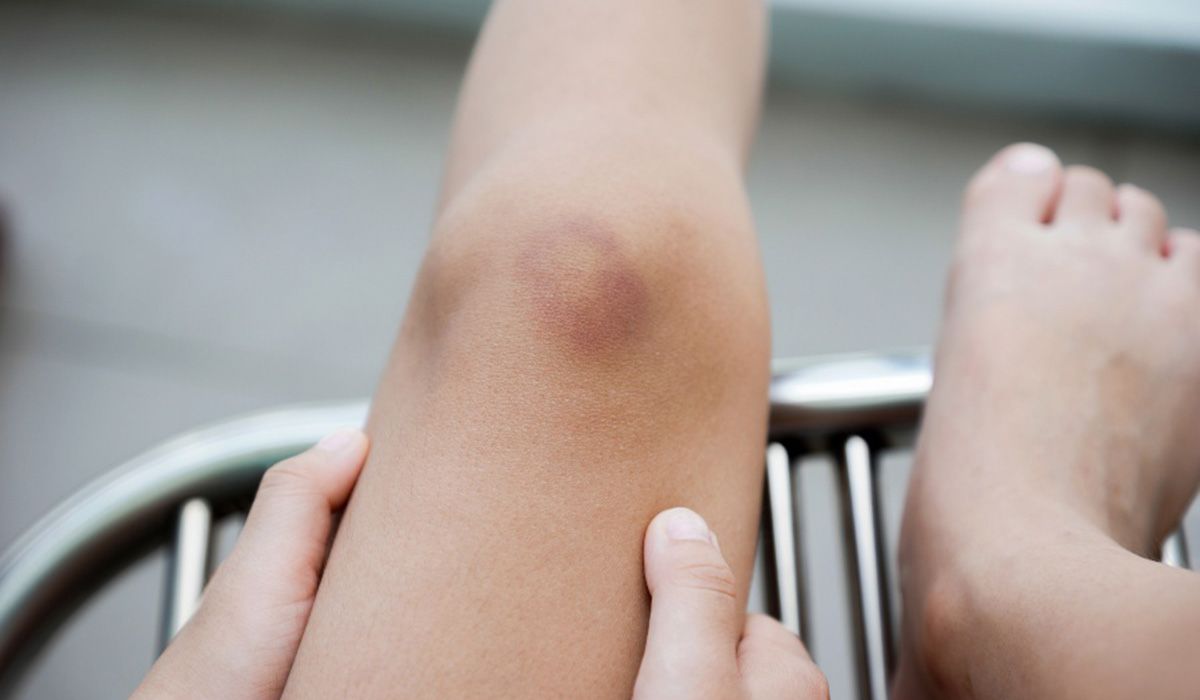 Child with bruises on the knee