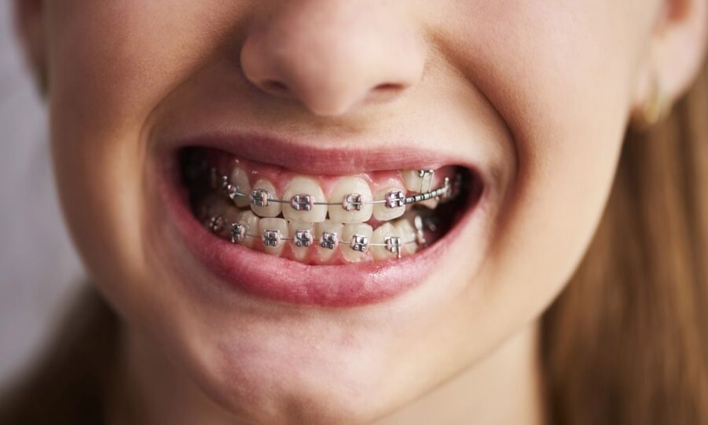 Dental brace